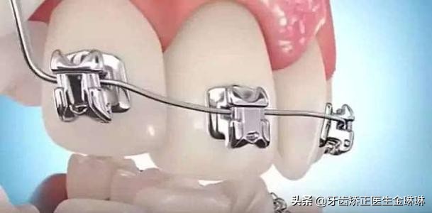 箍牙齿期间的必知小常识,箍牙的禁忌