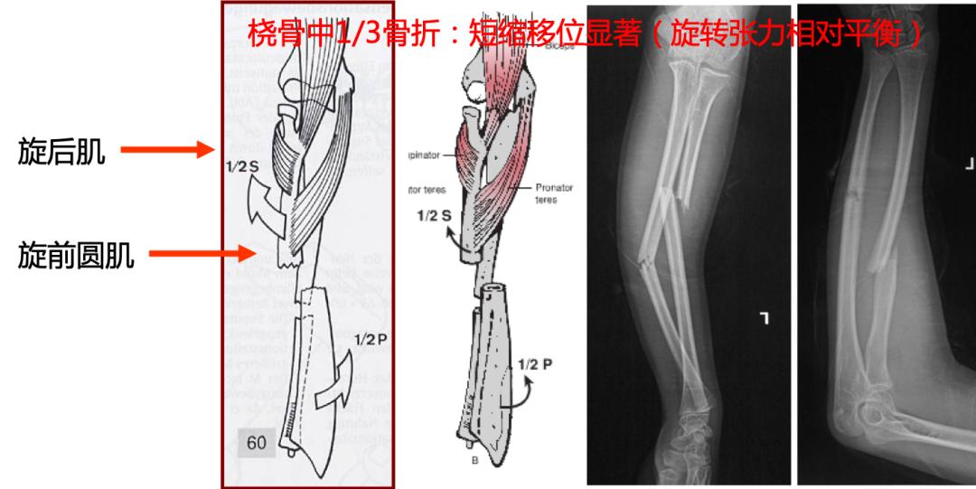 两个儿童前臂骨折争议病例之——元芳你怎么看