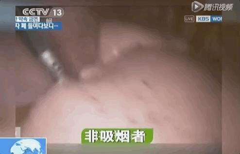 打开死者的肺，才明白有3亿人，在悄悄花钱买死