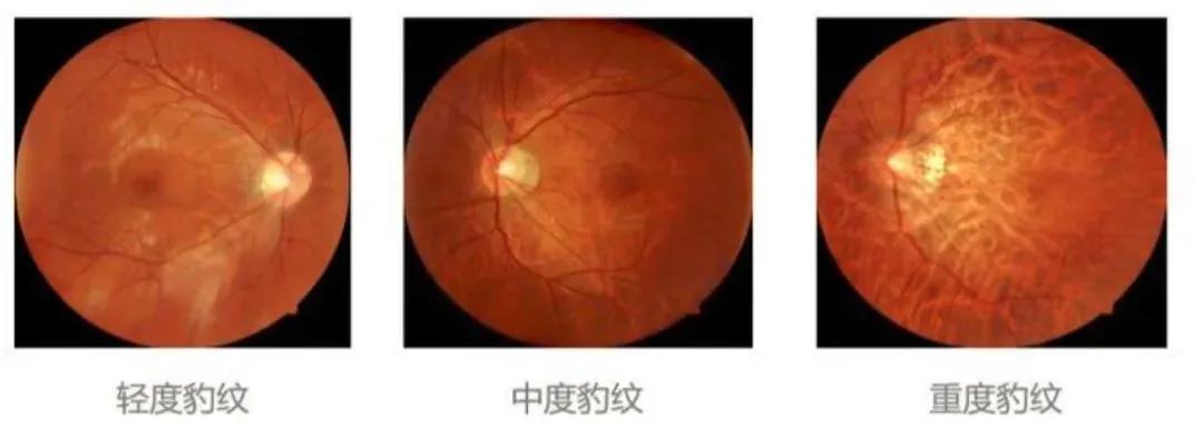 巩膜加固为什么能防止视网膜脱落,后巩膜加固术近视度数降低