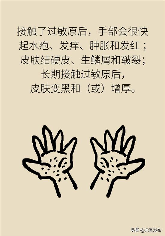 湿疹膏有哪些治疗效果好的,湿疹膏可以治愈吗