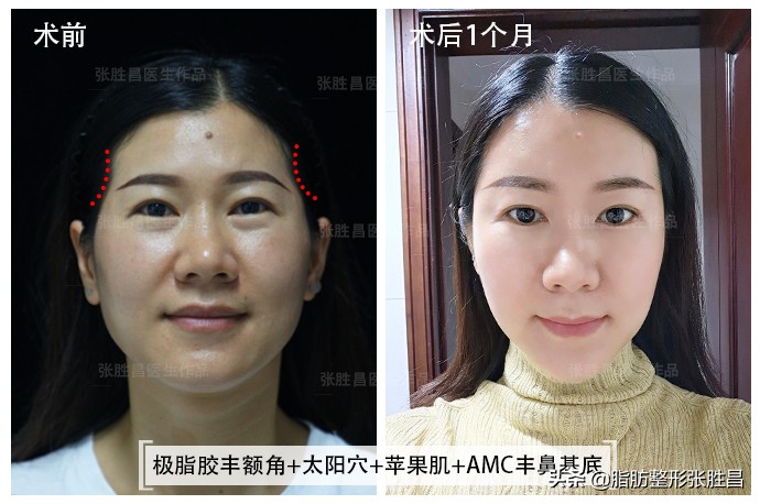 自体脂肪除皱是怎么样的,自体脂肪除皱的优点缺点有哪些