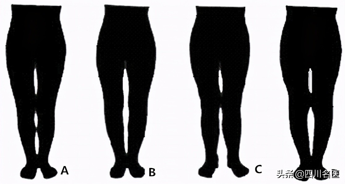 怎么判断腿是骨头弯还是肌肉弯,腿型矫正变直的方法骨科