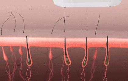 战胜了毛毛,就能滑溜溜的过夏天啦!