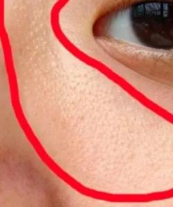 你长得真的是脂肪粒吗?如何解决“脂肪粒”?