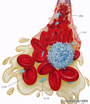 慢性高原病引起的原因,慢性高原病诊断标准2004
