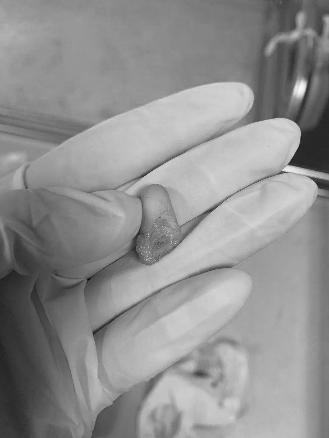 断指再植接动脉显微镜视频,穿针引线手术