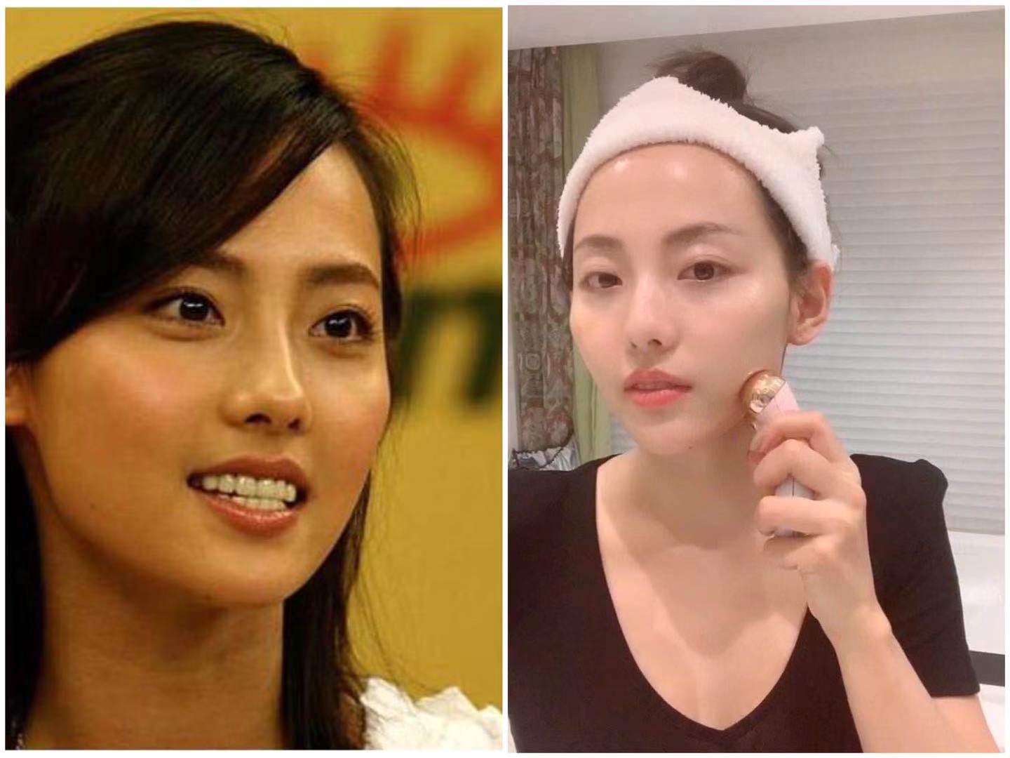 美容针变“毒针”，19岁女孩被毁容，医生：打针有风险跟风需谨慎