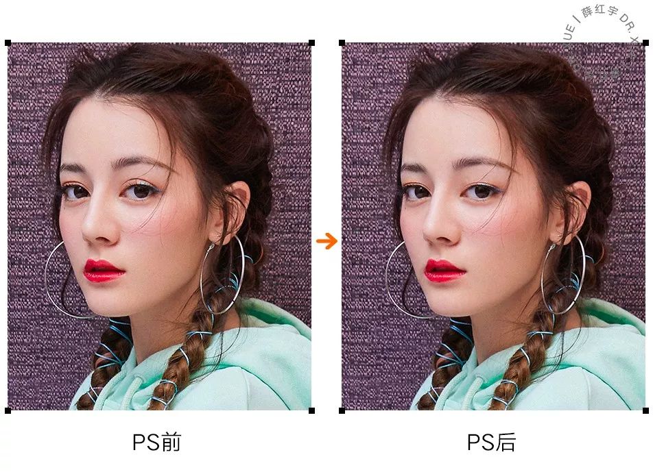 无痕双眼皮大概要多少钱,无痕双眼皮闭眼有痕