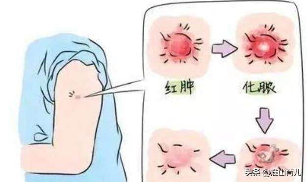 宝宝湿疹可以打麻风疫苗吗,宝宝黄疸是否能接种疫苗