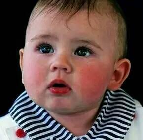 宝宝脸红起湿疹用什么面霜,宝宝冬季脸红湿疹冻疮如何应对