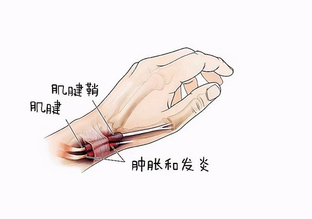 得了妈妈手——腱鞘炎,真的需要封闭治疗吗?杨大夫为你揭秘