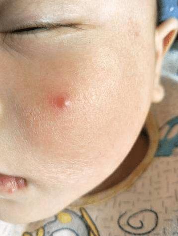 一岁宝宝老是揉脸怎么回事,婴儿脸上长痘痘一直用手搓