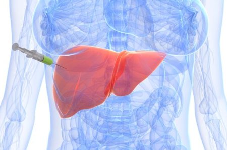 肝硬化出现蜘蛛痣是什么原因,肝硬化有蜘蛛痣的概率有多大