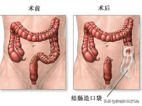 直肠癌手术结肠造口还是回肠造口,直肠癌造口后还需要做肠镜