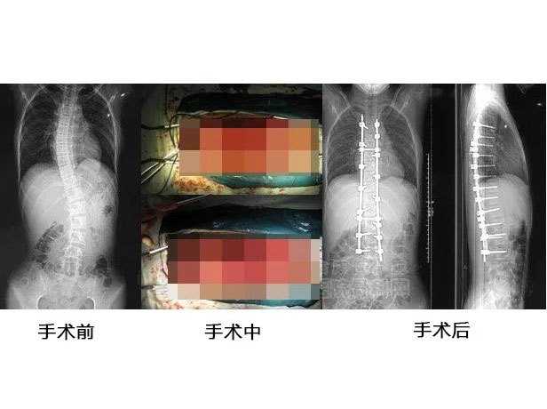 正美体态改善扁头是真的吗,成年人脊柱侧弯能恢复正常体态吗