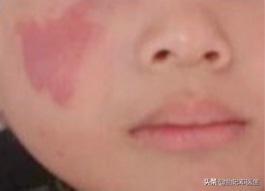 为什么红胎记会突出皮肤表面,为什么红胎记这么难治疗