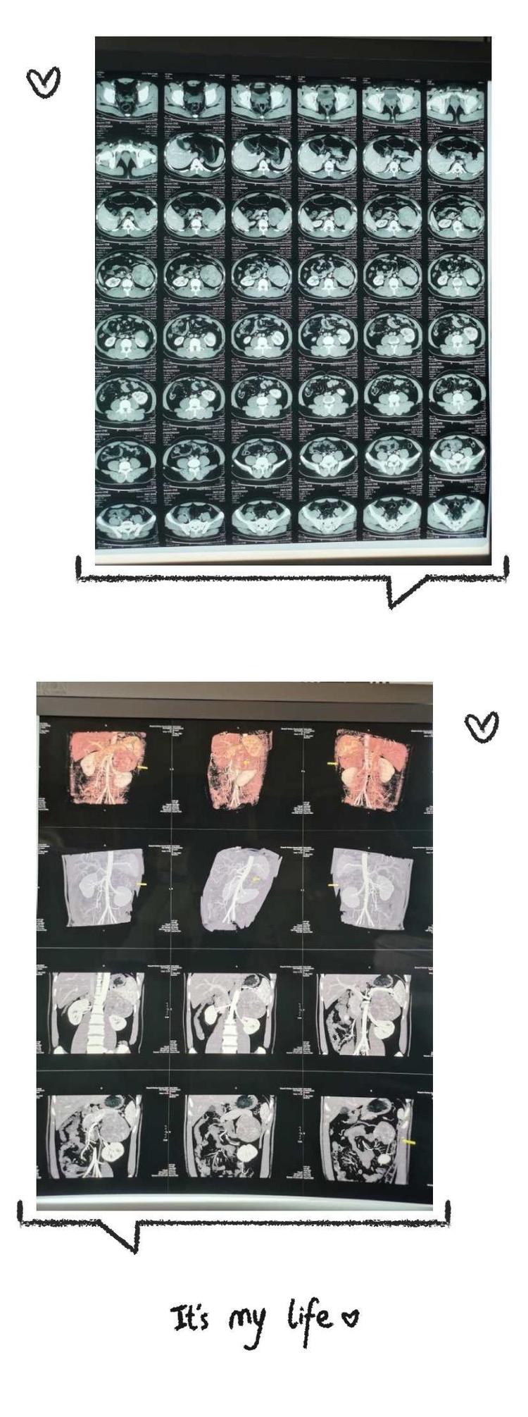腹腔镜下肾上腺肿瘤,腹腔镜下肾上腺肿物切除术