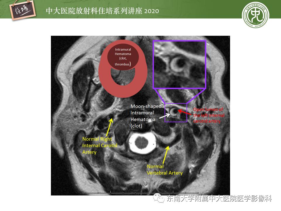 颈动脉夹层的超声表现及漏诊分析,动脉夹层与夹层动脉瘤是一样的吗