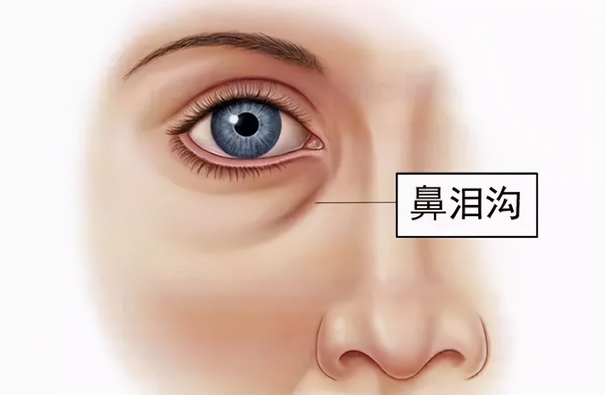 分不清泪沟眼袋印第安纹,眼袋泪沟填充好还是手术好