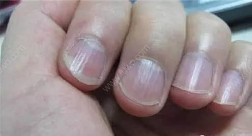 指甲有竖条纹是大病的前兆吗,指甲出现褐色竖纹代表什么病