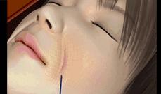 全脸线雕做完即刻提升效果不明显,做完线雕即刻效果不明显