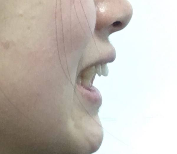 父母必看孩子教育,父母换牙需要注意什么