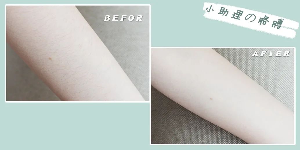 脱毛和祛痘,皮肤脱毛以后要注意什么