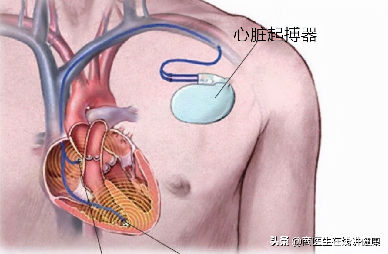 心跳越慢越长寿减少剧烈运动,心跳越慢人会更长寿