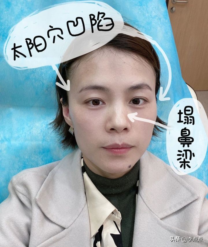 熬夜写完了医美后续，美真的是要付出代价的