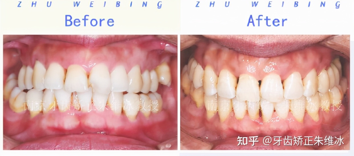 南京牙齿矫正龅牙前突要多少钱,36岁牙周不好龅牙能整吗