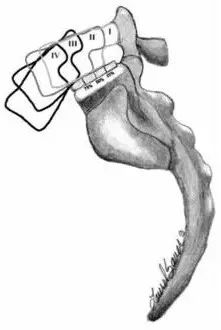 椎弓崩裂怎么知道是先天还是后天,椎弓崩裂的原理