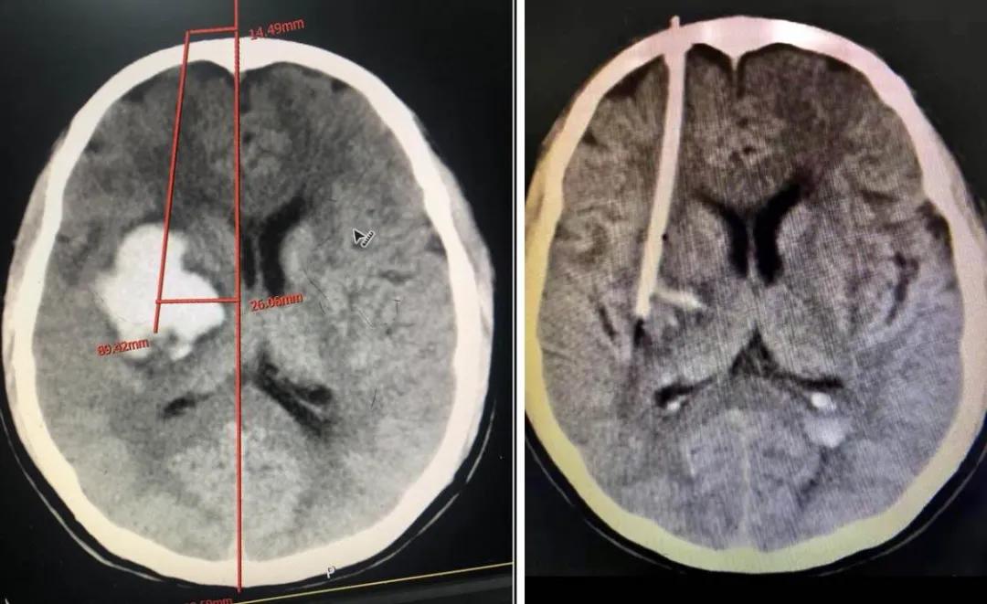 泉州:突破!永春县总医院成功开展新技术