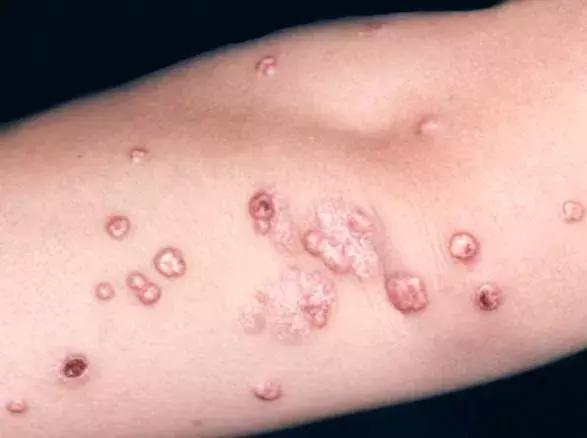 去游泳池游泳怎么预防病毒传染,游泳池防被传染小妙招