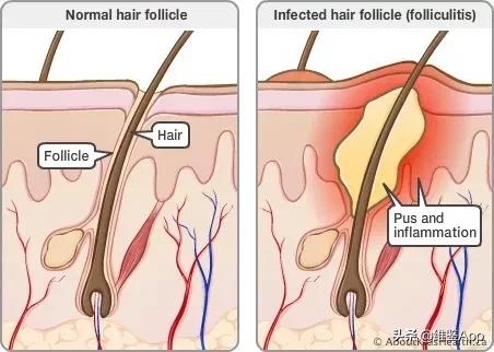 挤痘一定要挤出血吗,徒手挤了痘痘怎么办