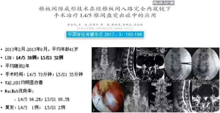 经皮腰椎间盘切除术有何优缺点,什么是经皮内镜腰椎手术