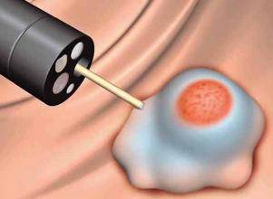 胃肠息肉会癌变么,长蒂息肉和无蒂息肉哪种容易癌变