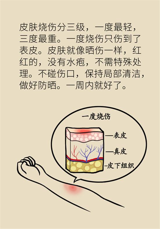 烫伤水泡如何换药,深2度烫伤换药总是有大水泡