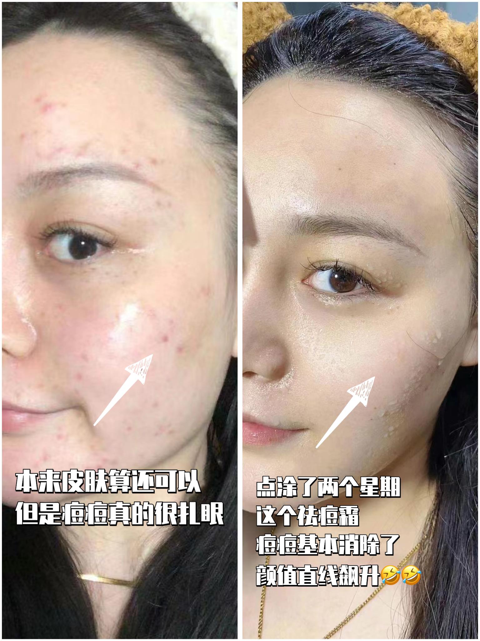 德朗芙的净痘霜真的好用吗，亲测祛痘痘真的推荐这个