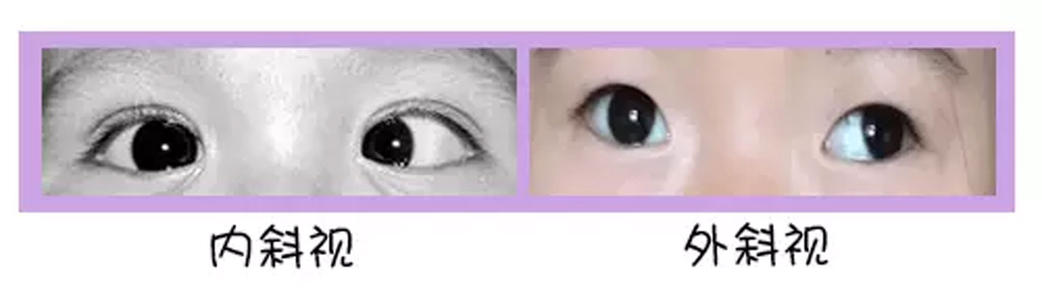 新生儿怎么预防眼睛有斜视,为什么新生儿看人都斜眼