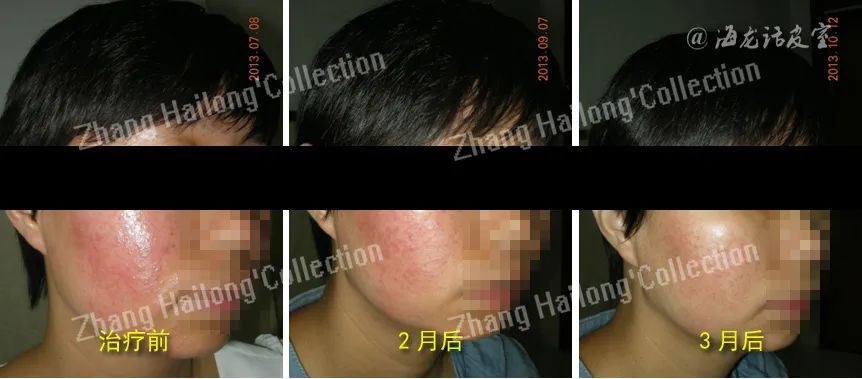 激素依赖性皮炎能自愈吗,激素依赖性皮炎能根除吗