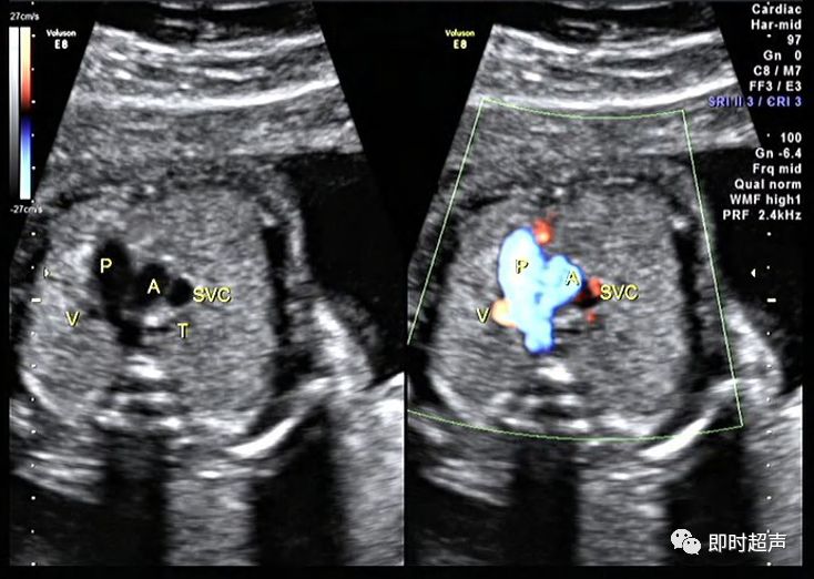 胎儿心脏三种血管关系模式图,25周的胎儿心脏弓切面多少正常