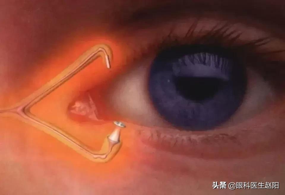 缓解干眼症的眼药水推荐,缓解干眼症的眼药水便宜