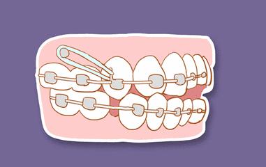 矫正牙齿你要知道的事,牙齿矫正路漫漫