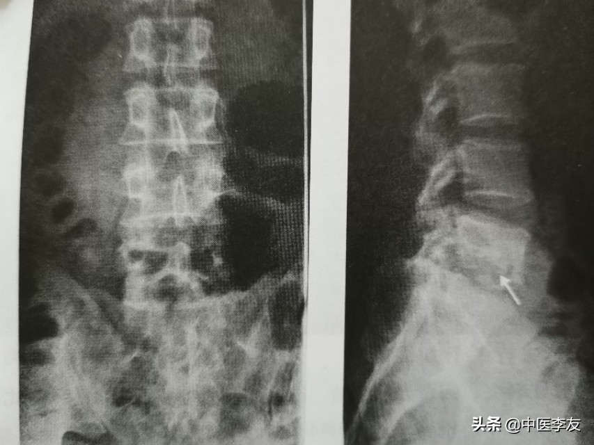 腰椎骨结核治愈后出现腰疼,脊柱结核腰痛怎么治