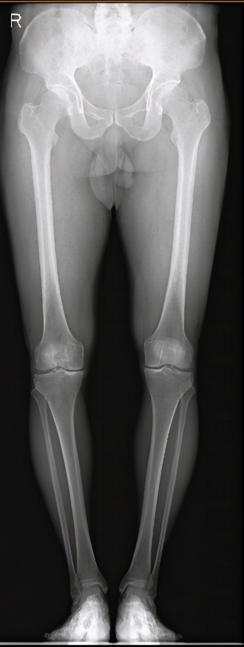 膝关节阶梯治疗ppt,膝关节骨性关节炎阶梯化治疗