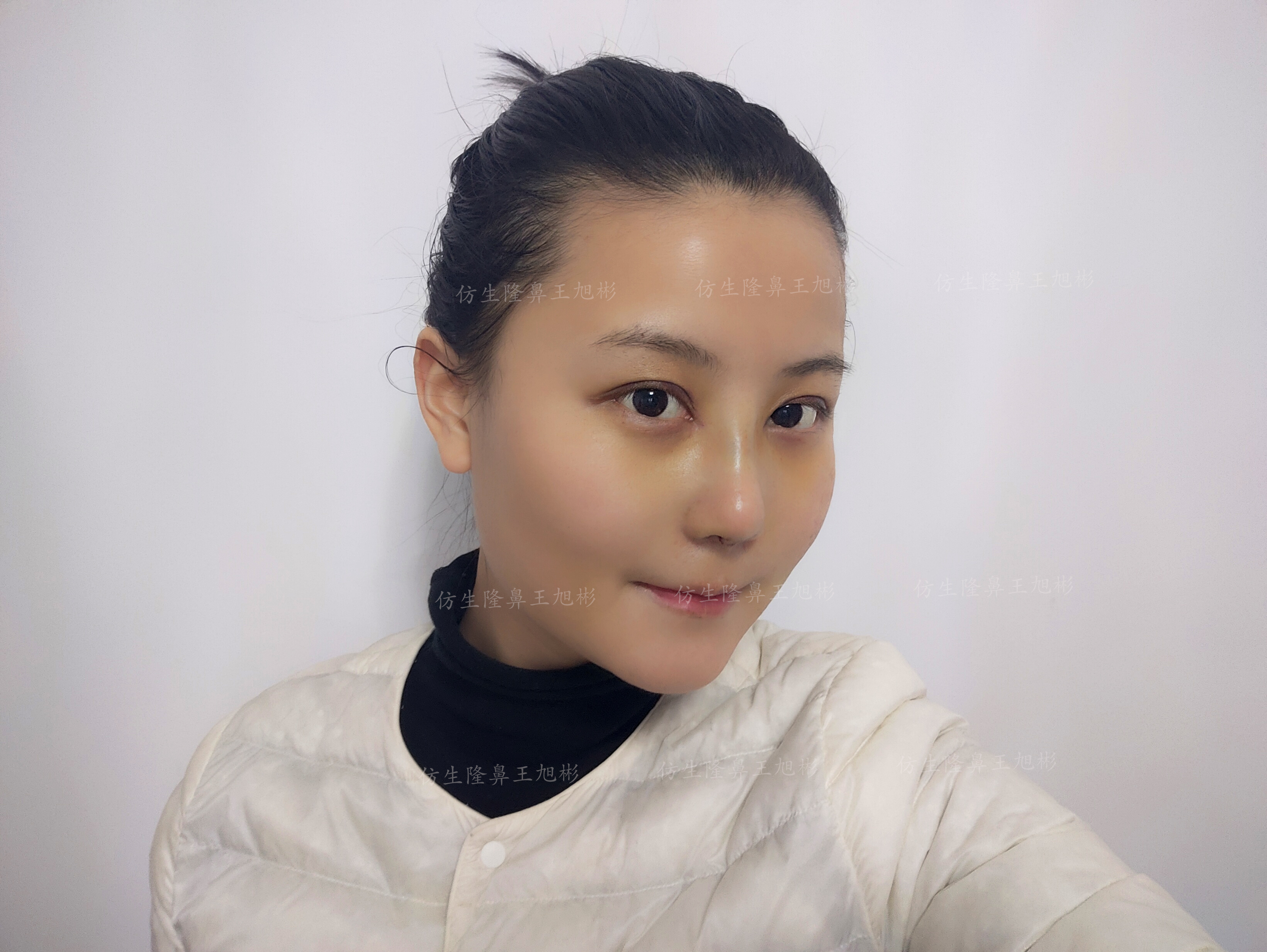 五官扁平的大饼脸,大饼脸和扁平五官怎样自救