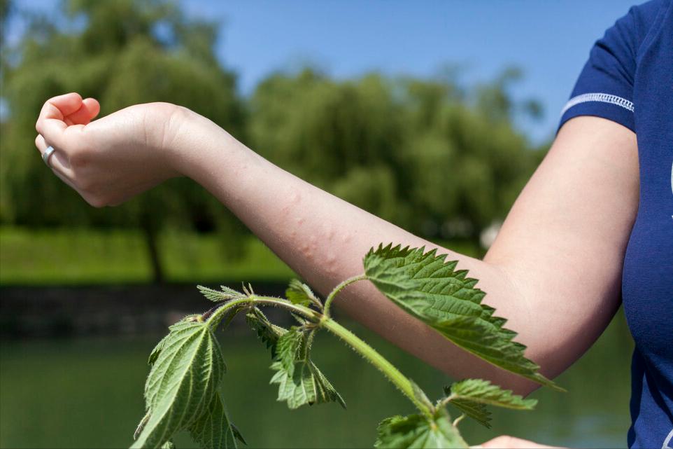 中医治疗荨麻疹怎么才可以治断根,中医麻疹最早期的诊断