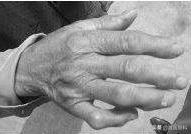 手指僵硬骨关节炎的治疗,手指关节肿大是骨关节炎能治好吗