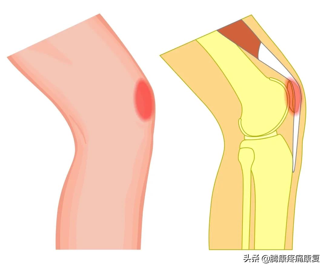 髌股关节疼痛综合症的检测方法,髌股关节疼痛综合征